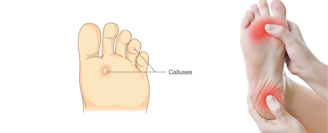 why-do-diabetics-have-foot-problems-plusock