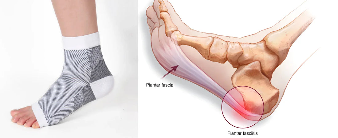 What Is Plantar Fasciitis and What Causes It?