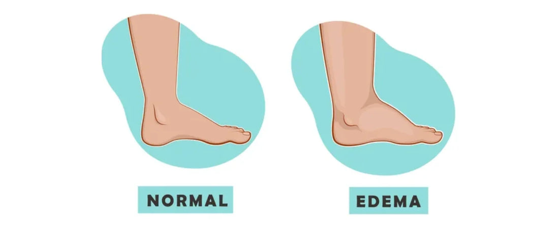 How to Fix Swollen Feet